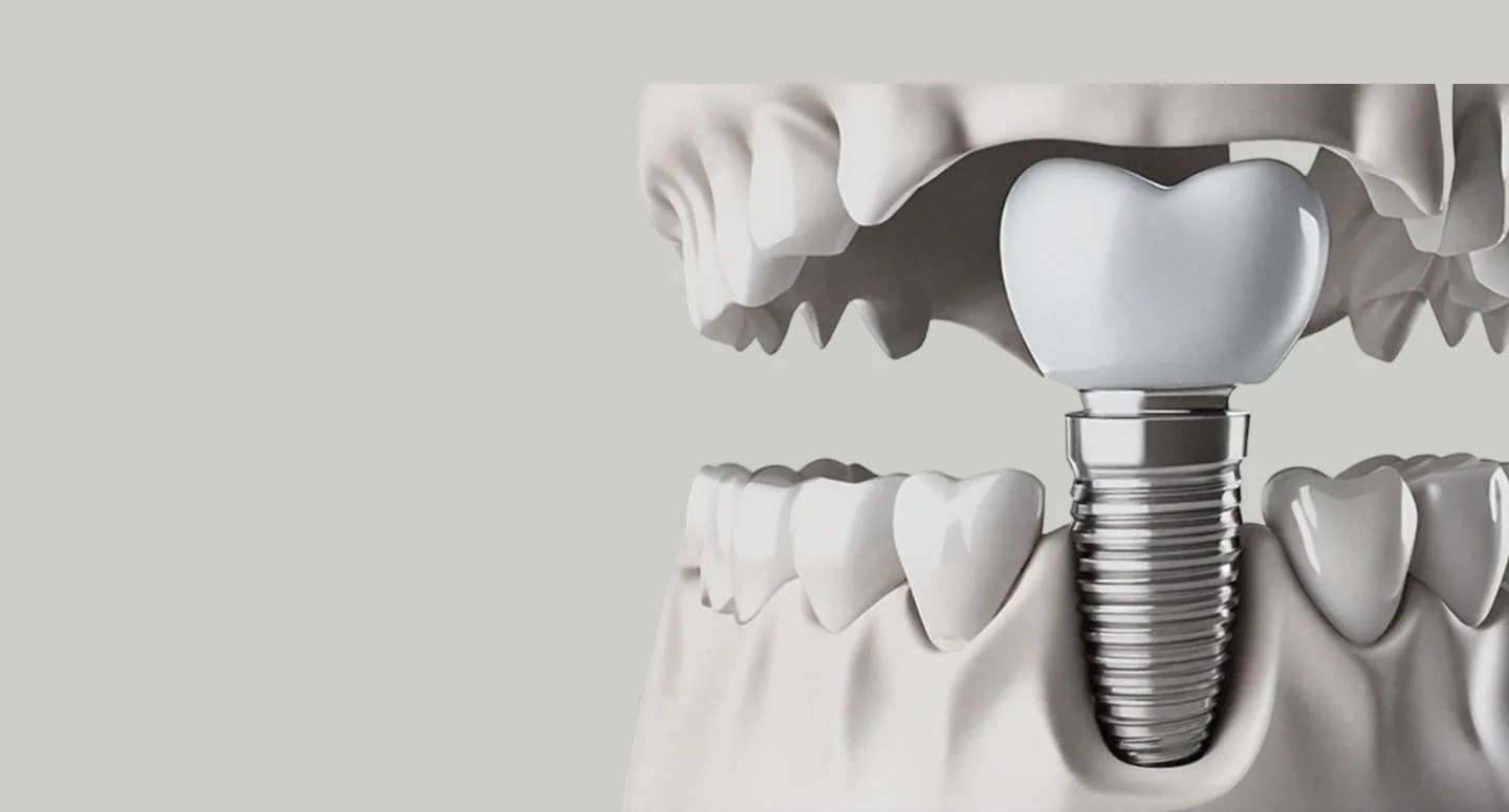 Dental surgical guide